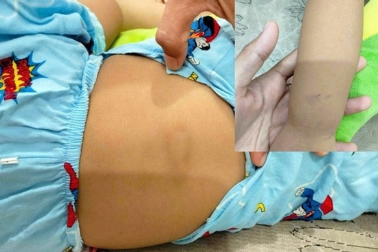 Nghi vấn bé gái gần 3 tuổi bị bạo hành tại điểm giữ trẻ ở Bình Thuận, bác sĩ chẩn đoán gì?