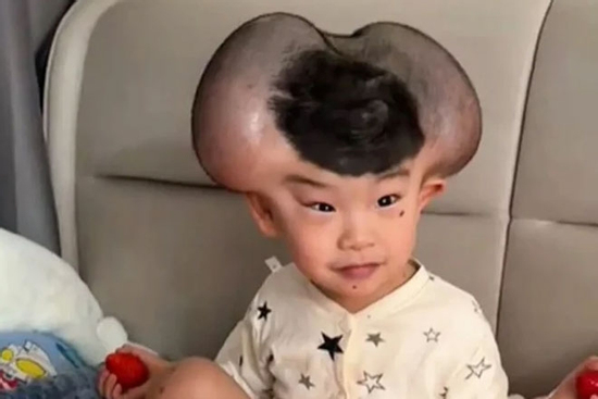 Nốt ruồi khổng lồ phủ kín hộp sọ khiến cậu bé có ngoại hình giống chuột Mickey