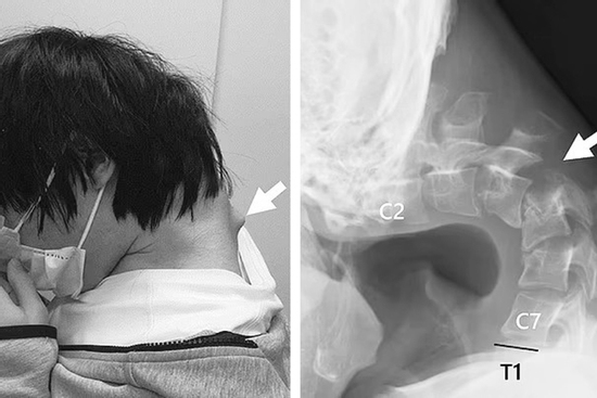 Hình ảnh cổ vẹo vọ đáng sợ của nam thanh niên vì sở thích quen thuộc