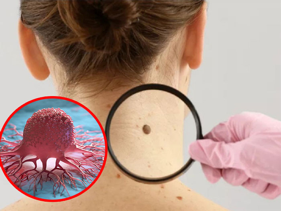 Lưu ý: Nốt ruồi ở ba vị trí này có liên quan mật thiết đến ung thư, nên xử lý kịp thời
