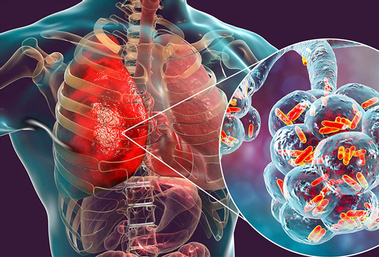 Ung thư phổi không triệu chứng trở thành chủ đề nóng! Bác sĩ nhắc nhở: Cần cảnh giác những dấu hiệu này