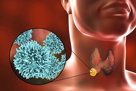 3 loại rau bị liệt vào 'danh sách đen thúc đẩy ung thư tuyến giáp'! Người có nhân tuyến giáp cần lưu ý!
