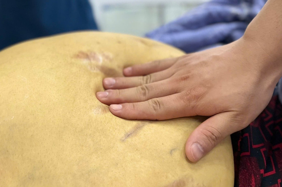 'Nát' gan, đối mặt ung thư vì thói quen nhiều người Việt vô tư làm