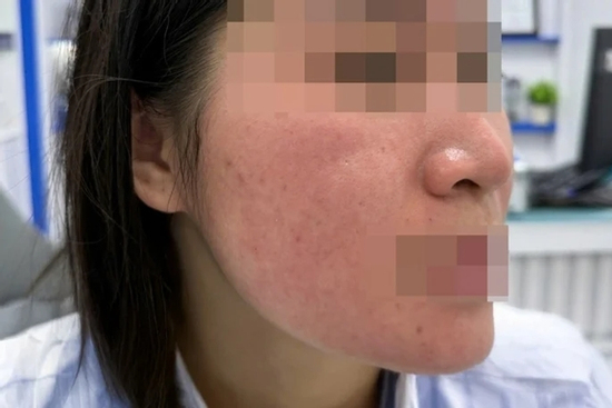 Bỏng da mặt vì dùng chanh tươi trị mụn
