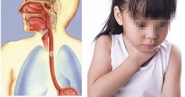 Bé trai 5 tuổi suýt thủng thực quản vì hóc xương cá ba sa
