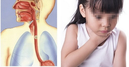 Bé trai 5 tuổi suýt thủng thực quản vì hóc xương cá ba sa