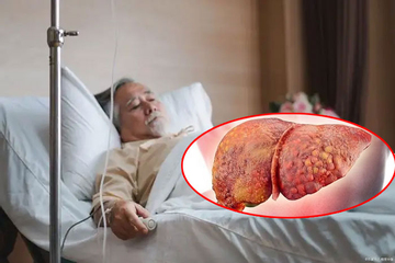 Ngày càng có nhiều người chết vì ung thư gan! Bác sĩ nhắc nhở: Ăn ít khoai tây chiên và ăn nhiều 3 loại thực phẩm này