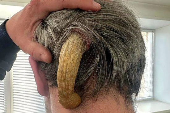 Người đàn ông mọc sừng sau đầu, hơn 25 năm hành nghề bác sĩ mới gặp 1 lần