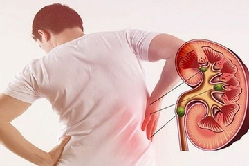 Sỏi tiết niệu hiểm hoạ thầm lặng có thể gây suy thận và tử vong