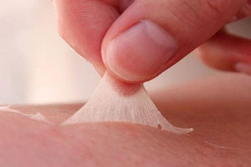 Dùng axit tẩy trắng da, cô gái bị bỏng toàn thân