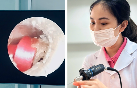 Bé gái suýt thủng màng nhĩ vì dị vật là sợi dây buộc tóc
