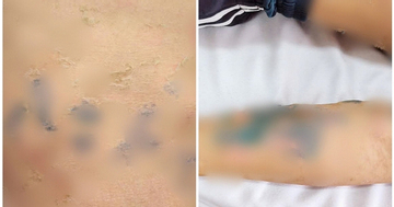 Tự đắp lá chữa bệnh sởi, nam thanh niên 17 tuổi nhập viện gấp