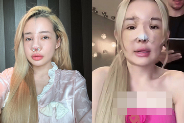 Gương mặt biến dạng của Ngân 98 sau hơn 10 lần dao kéo