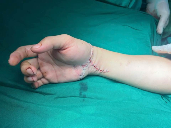 Nối lại thành công bàn tay bị chém lìa của nam TikToker có tiếng ở Thái Nguyên