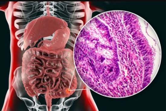 Tưởng rối loạn tiêu hóa, ai ngờ là ung thư: 5 dấu hiệu trực tràng không nên xem thường
