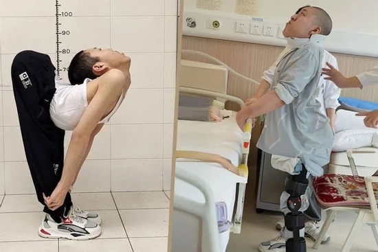 Chàng trai có cột sống gập hình chữ Z lần đầu đứng thẳng sau nhiều ca phẫu thuật