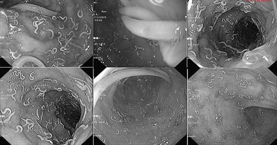 Liên tục bị tiêu chảy, bác sĩ sốc nặng khi nội soi cho bé gái