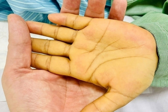 Sụt cân, mệt mỏi - cảnh báo sớm của ung thư gan ít ai ngờ