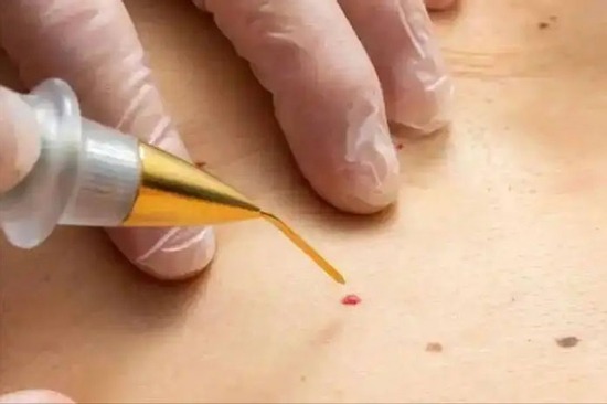 Nốt ruồi son xuất hiện trên cơ thể, dấu hiệu của bệnh nguy hiểm? Bác sĩ: Nếu có 3 đặc điểm bất thường cần đi khám