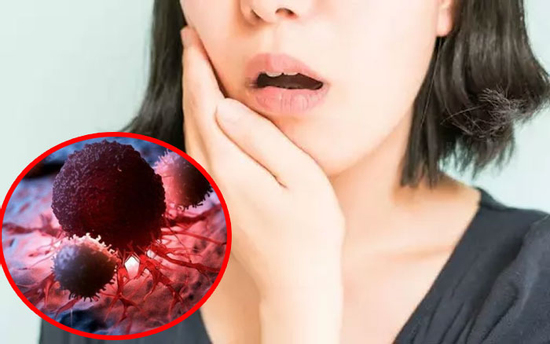 Đừng bỏ qua 3 bất thường này trong miệng, có thể là dấu hiệu của bệnh ung thư