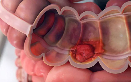 Đi vệ sinh thấy 5 dấu hiệu này, đi khám ngay kẻo ung thư 'ghé thăm'