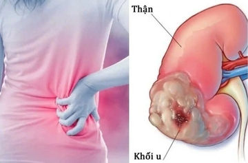 Dấu hiệu âm thầm của ung thư thận dễ bị bỏ qua