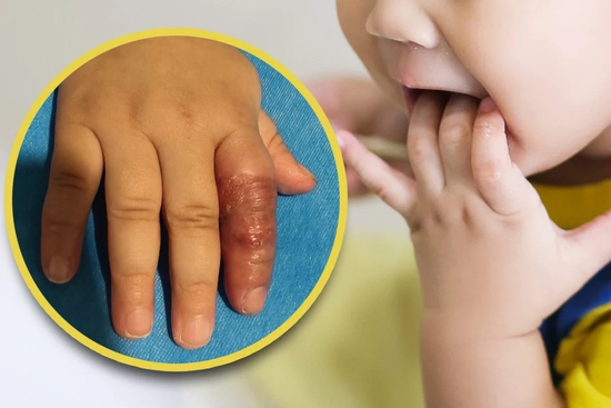 Mẹ dùng băng quấn để ngăn con mút tay, em bé suýt phải cắt cụt ngón
