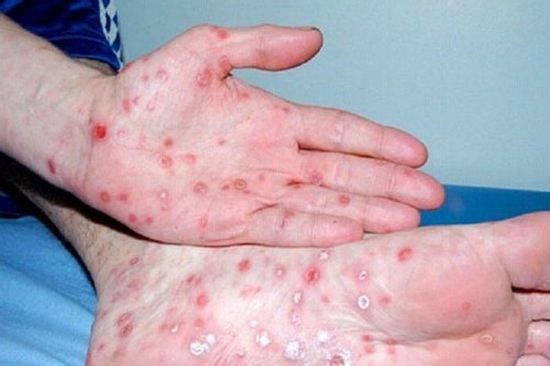 Tại sao ngày càng nhiều người mắc giang mai? Cảnh báo: Ngoài quan hệ tình dục nguy cơ cao, 3 hành vi cần được kiểm soát