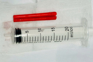 Hai đoạn đũa nhựa dài 5–6cm trong mũi người đàn ông suốt hơn 1 năm