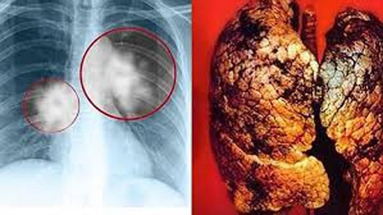 Bác sĩ cảnh báo: Dấu hiệu sớm của ung thư phổi không phải đau ngực, mà là 5 triệu chứng bất thường này, nhiều người bỏ qua