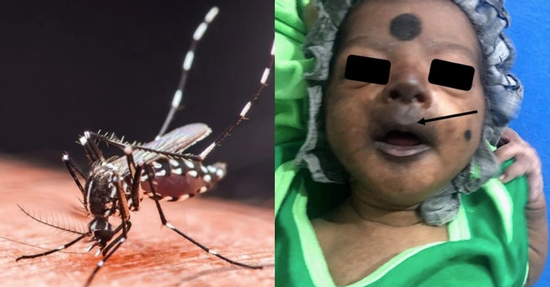 Chikungunya từng khiến bé sơ sinh mặt tím đen, phải nhập viện khẩn cấp