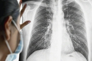 Lý do nhiều người không hút thuốc vẫn bị ung thư phổi