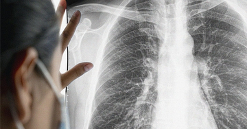 Người vợ mắc ung thư giai đoạn cuối do thói quen của chồng