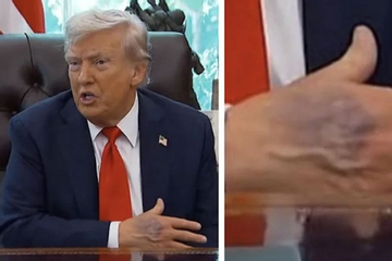Bàn tay thâm tím của ông Trump gây chú ý