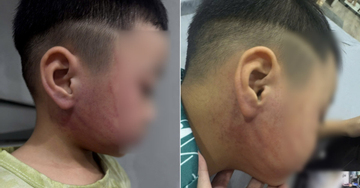 Bé 4 tuổi nghi bị giáo viên mầm non ở Hà Nội đánh bầm tím mặt