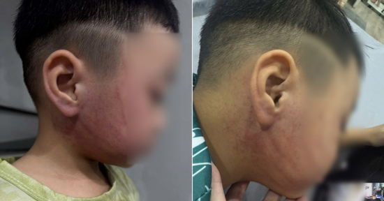 Bé 4 tuổi nghi bị giáo viên mầm non ở Hà Nội đánh bầm tím mặt