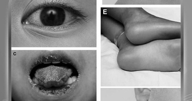 Sốt cao nhiều ngày, bé 5 tuổi đi khám phát hiệm bệnh hiếm gặp