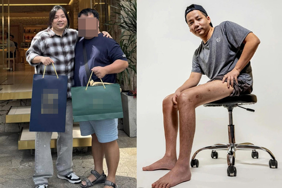Sốc hình ảnh trên ngắn dưới dài của Khoa Pug khi chi tiền tỷ phẫu thuật kéo chân