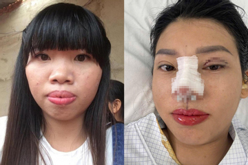 Thị Nở tái sinh Quách Phượng tiếp tục thẩm mỹ, diện mạo mới gây bất ngờ