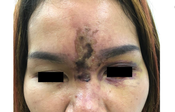 Tiêm filler làm đẹp: Tan nát mặt từ 'bác sĩ' chui