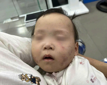 Làm rõ nguyên nhân bé gái bị bầm tím mặt khi gửi ở nhà trẻ Bắc Ninh
