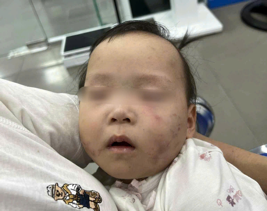 Làm rõ nguyên nhân bé gái bị bầm tím mặt khi gửi ở nhà trẻ Bắc Ninh