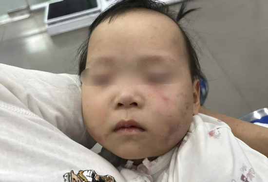 Bé gái 1 tuổi bị bầm tím mặt khi gửi nhà trẻ ở Bắc Ninh: Công an tạm giữ cô giáo