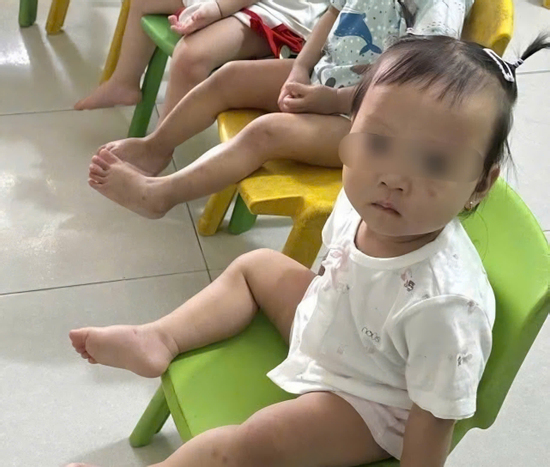 Tình trạng sức khỏe bé gái 1 tuổi bị bầm tím mặt khi gửi nhà trẻ ở Bắc Ninh
