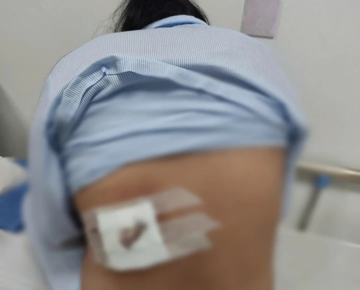 Đắp lá điều trị mụn lưng, người phụ nữ ở Quảng Trị bị hoại tử