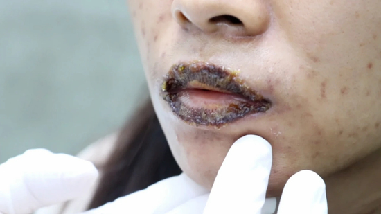 Làm đẹp cấp tốc, nhiều người 'tiền mất tật mang'