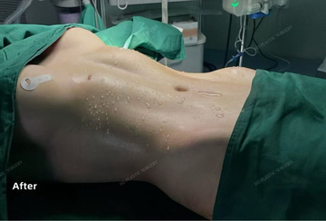 Xu hướng bẻ xương sườn để có vòng eo con kiến