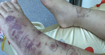 Chuyên gia cảnh báo về một căn bệnh nguy hiểm, lây lan nhanh, tỉ lệ tử vong cao