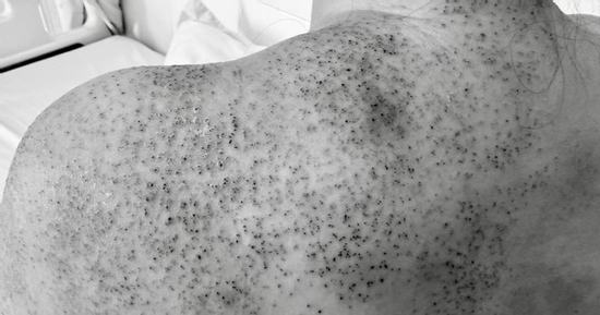 Người phụ nữ nhập viện cấp cứu sau khi chích lể, giác hơi