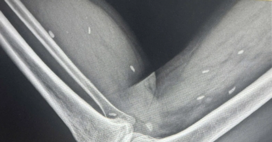 Hình ảnh X-quang gây sốc ở người đàn ông có thói quen ăn đồ sống